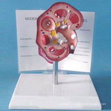 Medical Teaching Human Renal Calculus Anatomic Model (R110107)